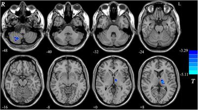 Reduced Global-Brain Functional Connectivity of the Cerebello-Thalamo-Cortical Network in Patients With Dry Eye Disease